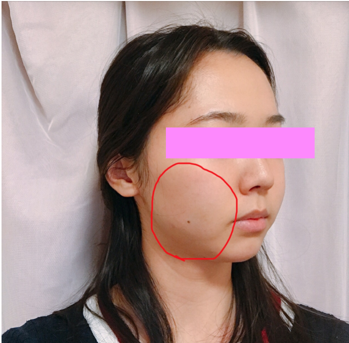 Bnlsで顔が腫れた 東京ロイヤルクリニックでbnlsの小顔注射を打った結果 Bnlsモテ小顔